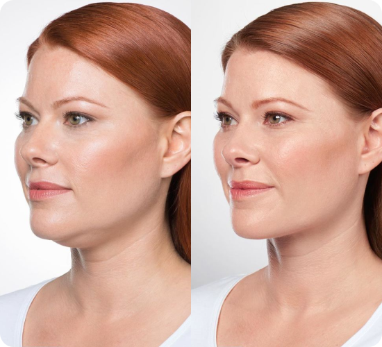 kybella | Kybella treatment | Kybella for double chin	